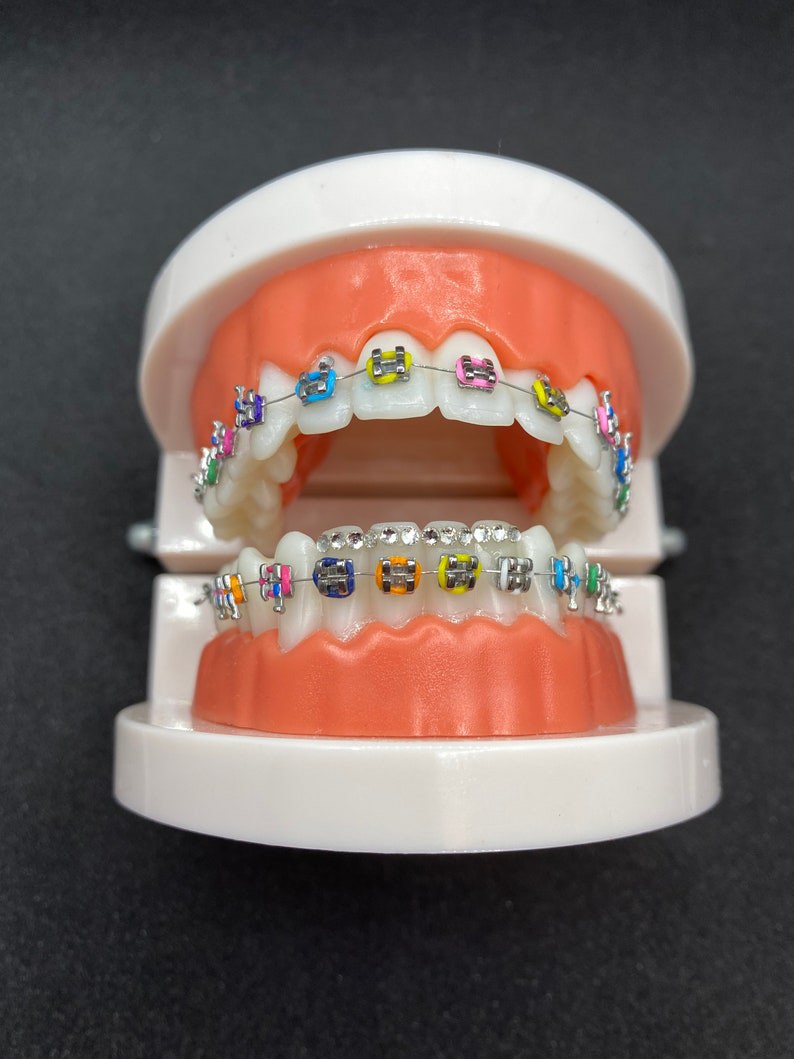 Buy Tooth Gem Kit for Braces Online in India 
